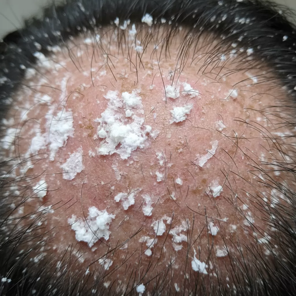 Tình trạng gàu kéo dài là dấu hiệu cảnh báo hàng rào bảo vệ da đầu đang bị tổn thương