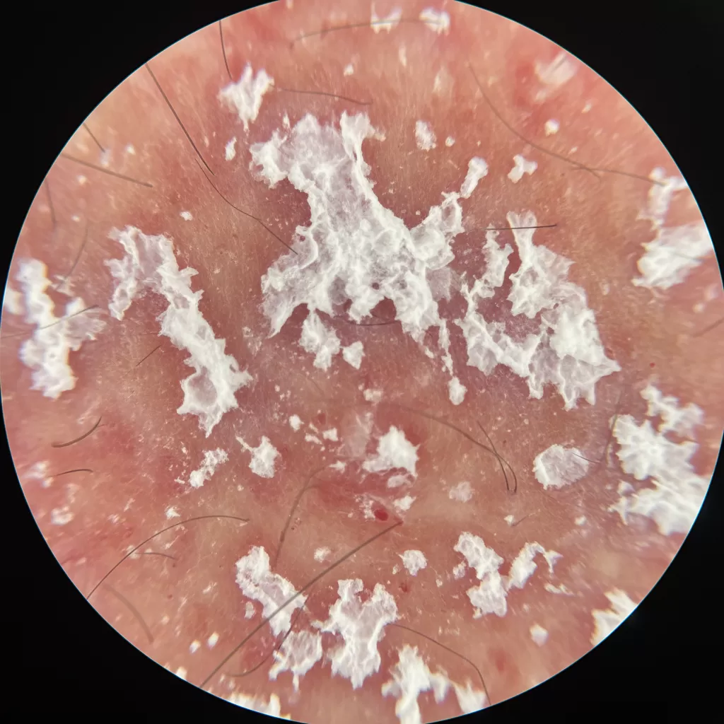 Cận cảnh tình trạng da đầu bị kích ứng và bong tróc vảy gàu