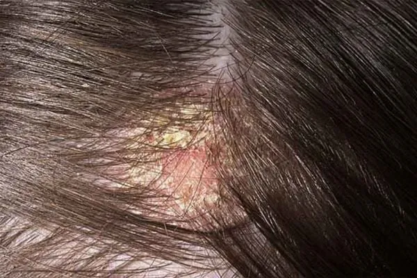 092349-bvdk-medic-bd Tình trạng nấm da đầu gây ngứa ngáy và bong tróc vảy gàu