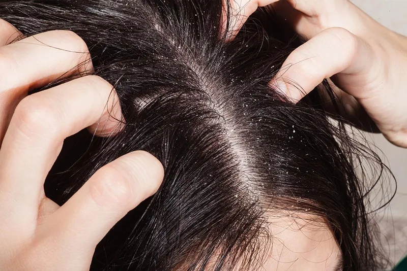 Hương liệu nhân tạo gây ngứa da đầu là một trong những nguyên nhân phổ biến nhất dẫn đến viêm da tiếp xúc