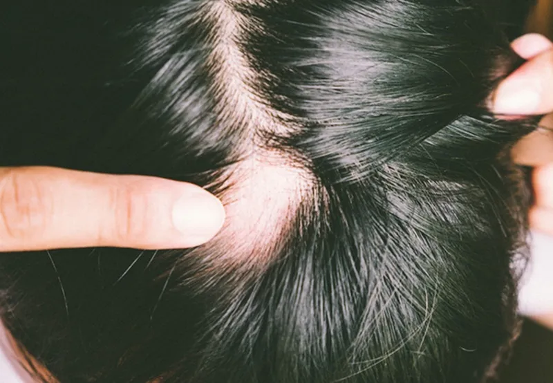 Mảng rụng tóc hình tròn đặc trưng của chứng Alopecia Areata