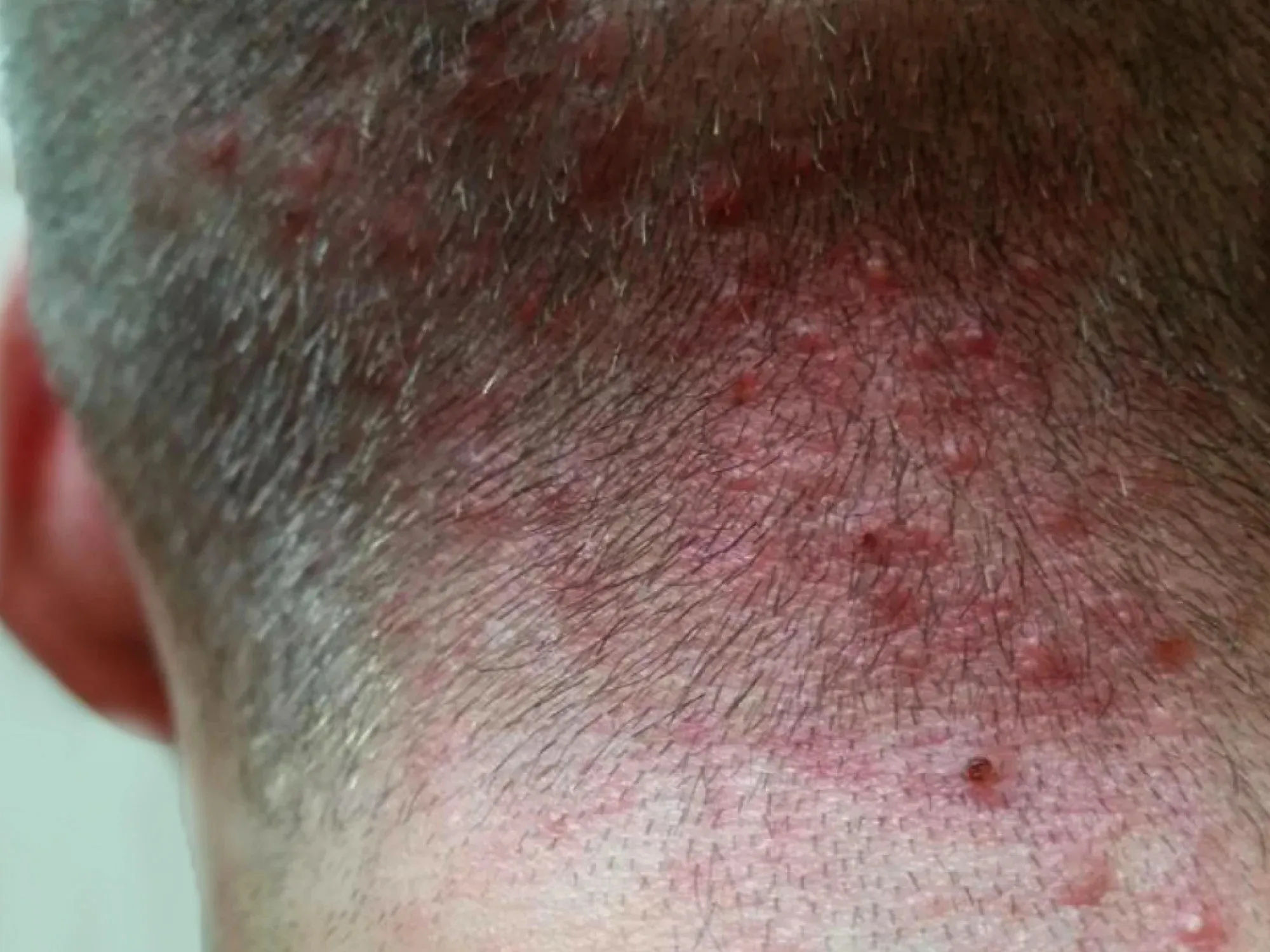 669692cbce18b40f0f8f27d6_scalp20folliculitis Viêm nang lông da đầu gây ra các nốt mụn đỏ và cảm giác khó chịu kéo dài