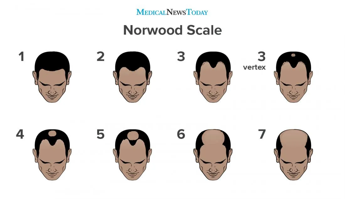 an-infographic-of-the-norwood-scale Các giai đoạn của hói đầu di truyền theo thang đo Norwood