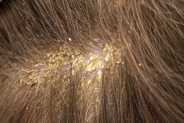 are_you_worried_about_oily_yellow_dandruff620 Sự tích tụ Pomade lâu ngày có thể dẫn đến tình trạng gàu và bít tắc lỗ chân lông