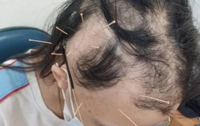 Tình trạng rụng lông mày và rụng tóc đồng thời thường là dấu hiệu cảnh báo các vấn đề sức khỏe tiềm ẩn