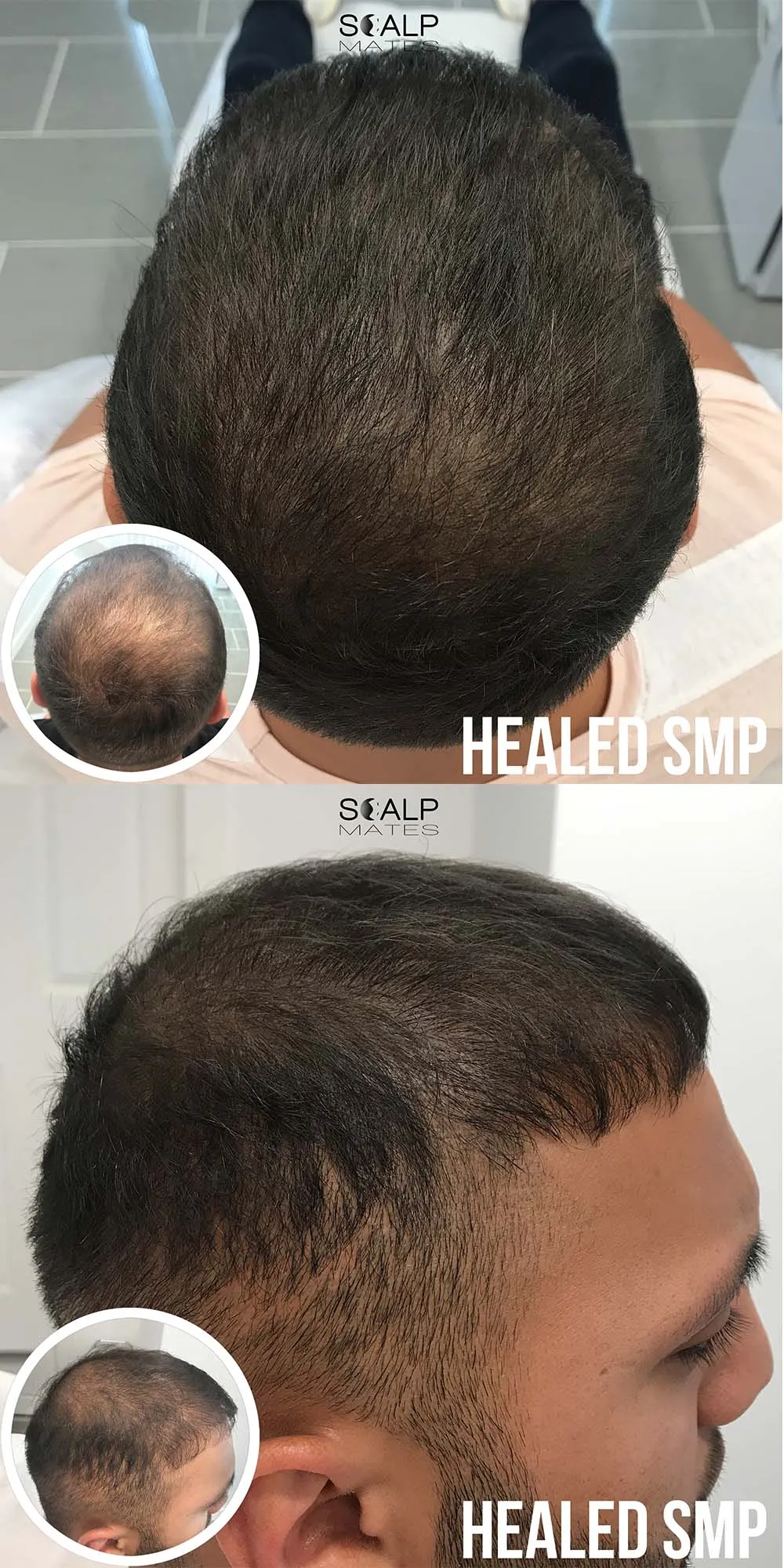 Kết quả phục hồi diện mạo ấn tượng trước và sau khi thực hiện xăm chân tóc cho nam giới bị hói