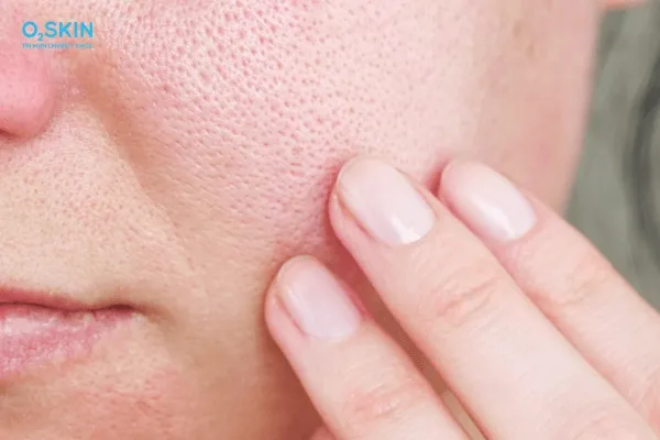 Sử dụng phấn rôm đúng tần suất giúp bảo vệ lỗ chân lông da đầu