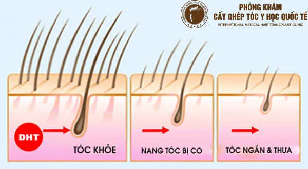 Cấu trúc nang tóc bị ảnh hưởng nghiêm trọng khi cơ thể thiếu hụt protein và khoáng chất