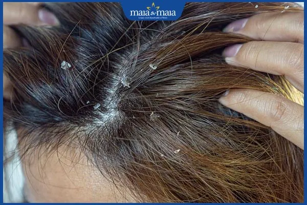 Nấm da đầu gây mất thẩm mỹ và ảnh hưởng nghiêm trọng đến sức khỏe mái tóc