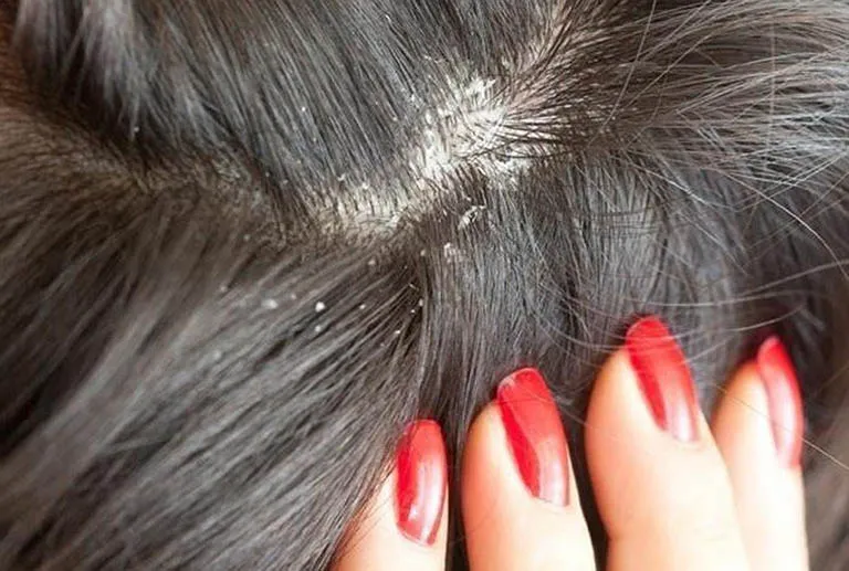 dau-nhieu-gau Sự tích tụ bột dầu gội khô có thể gây viêm nhiễm và bít tắc nang tóc nghiêm trọng