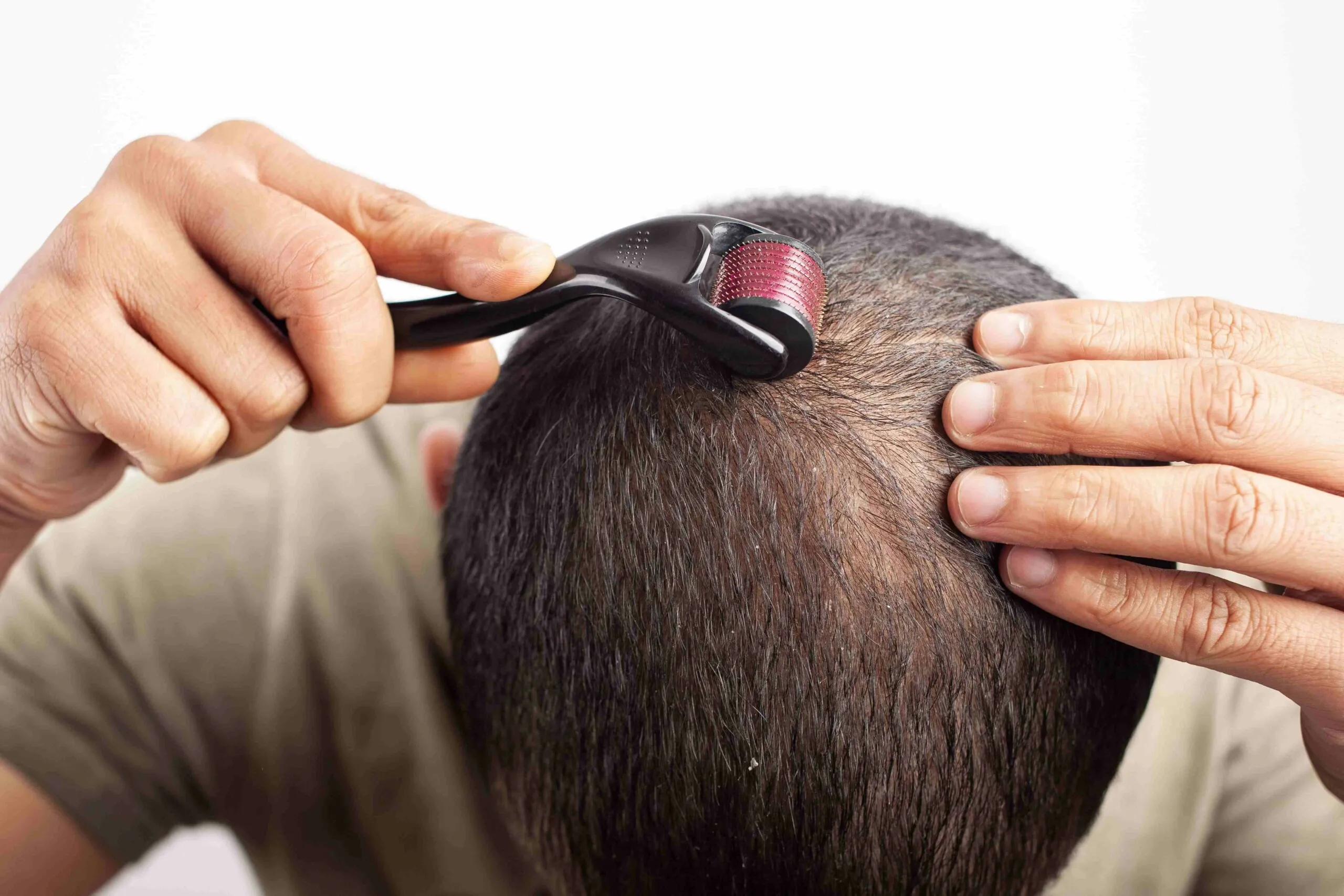 derma-roller-for-hair-growth Derma Roller Lăn kim kích nang tóc là phương pháp hiện đại giúp cải thiện mật độ tóc hiệu quả