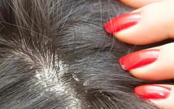 Tình trạng gàu gây mất tự tin và khiến nhiều người tìm đến các phương pháp tự nhiên như chanh