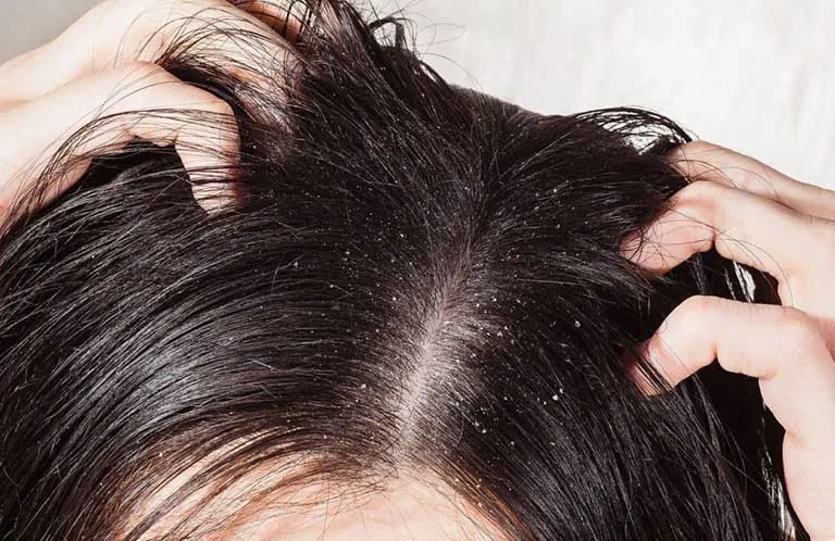Nhận biết sớm các dấu hiệu nấm da đầu nặng là vô cùng quan trọng để bảo vệ sức khỏe mái tóc