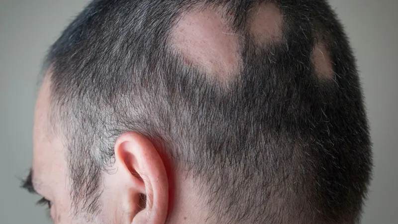 Sự khác biệt rõ rệt giữa rụng tóc sinh lý và rụng tóc bệnh lý thành mảng