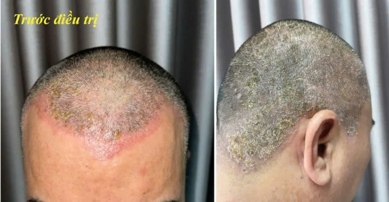 Sự thâm nhập của hóa chất qua hàng rào bảo vệ da gây viêm da tiếp xúc