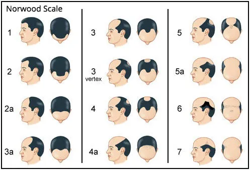 Các cấp độ hói đầu ở nam giới phù hợp để thực hiện phương pháp xăm chân tóc thẩm mỹ
