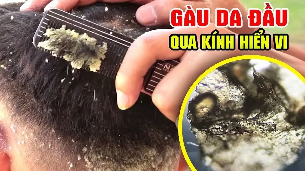 maxresdefault Độ ẩm thấp khiến da đầu bị khô và bong tróc làm suy yếu chân tóc