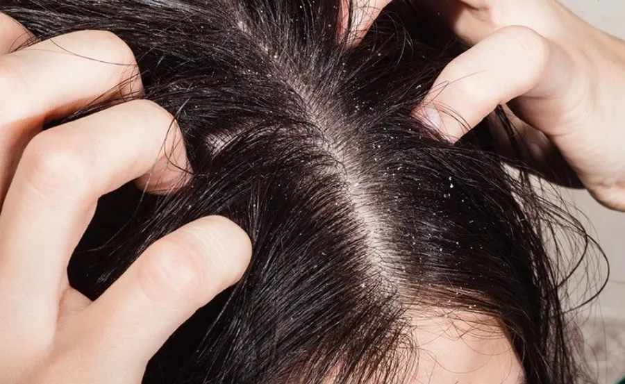 Tình trạng da đầu nhạy cảm ngứa ran gây ra nhiều bất tiện và lo lắng trong cuộc sống hàng ngày