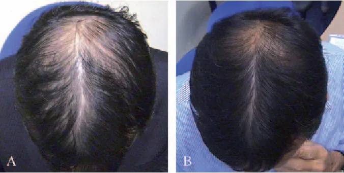 Việc duy trì sử dụng Minoxidil là cần thiết để giữ vững kết quả mọc tóc