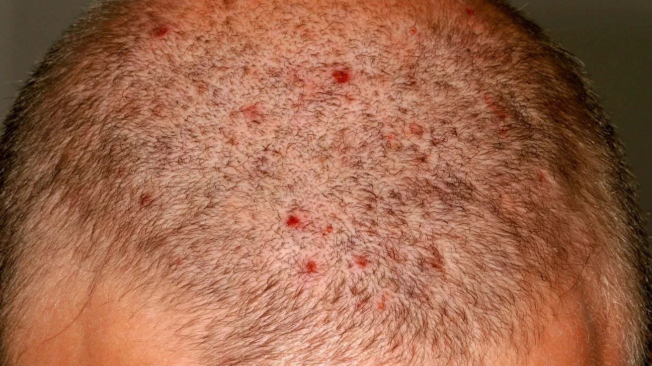 moderate_scalp_folliculitis-1296x728-gallery_slide3 Các triệu chứng điển hình của viêm nang lông bao gồm mụn mủ và vùng da xung quanh bị tấy đỏ