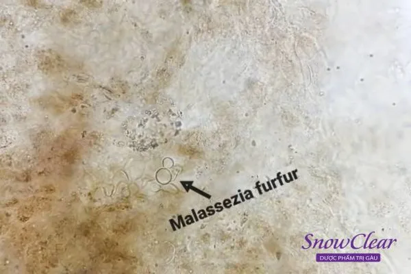 nam-malassezia-1 Nấm Malassezia bùng phát mạnh mẽ trong môi trường ẩm ướt và thiếu oxy