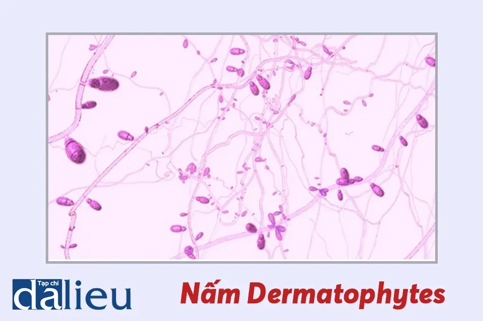 Vi nấm Trichophyton  tác nhân hàng đầu gây ra tình trạng nấm da đầu và rụng tóc