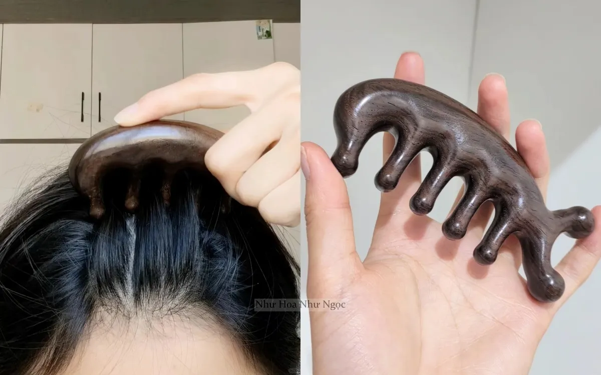 Rụng tóc là vấn đề phổ biến gây ảnh hưởng lớn đến tâm lý và thẩm mỹ