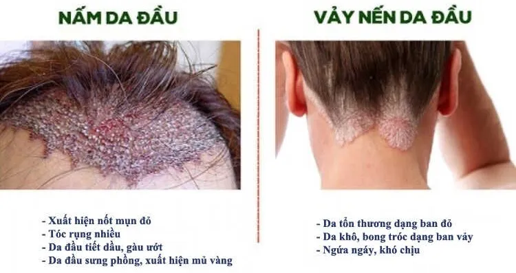 Sự khác biệt rõ rệt giữa tổn thương do vảy nến và nấm da đầu giúp người bệnh nhận diện chính xác