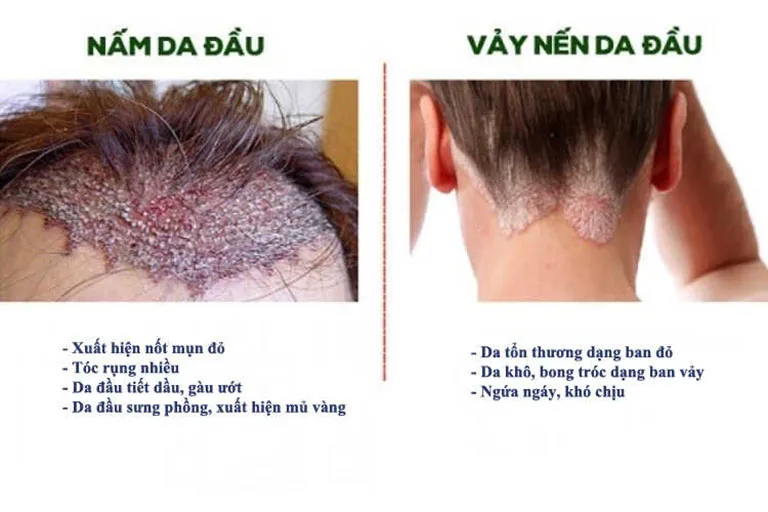 Sự khác biệt rõ rệt giữa vảy gàu trắng khô và vảy viêm da tiết bã vàng nhờn