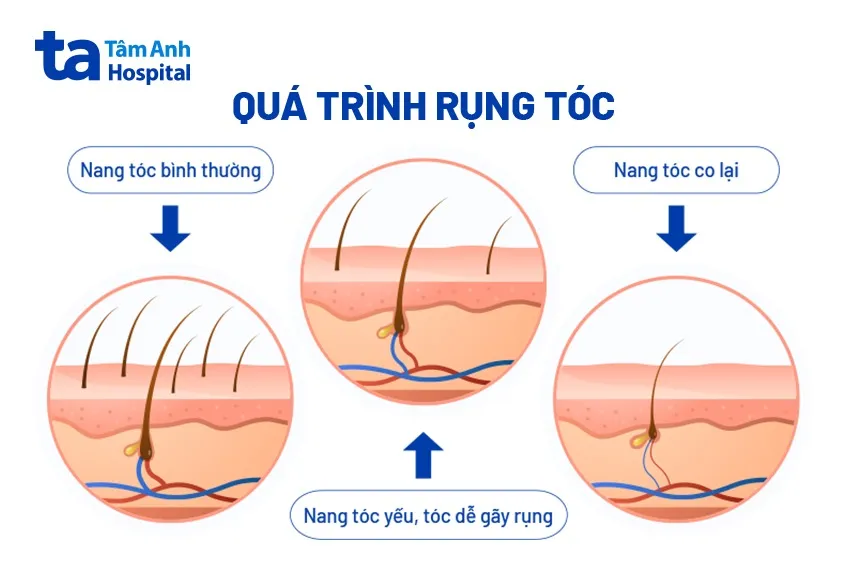 qua-trinh-rung-toc Cơ chế tự miễn là nguyên nhân chính dẫn đến tình trạng rụng tóc thành từng vùng