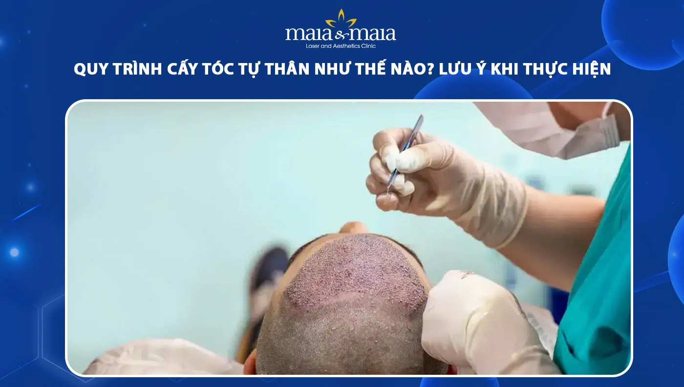 Cấy tóc tự thân là giải pháp tối ưu giúp phục hồi mái tóc tự nhiên và bền vững