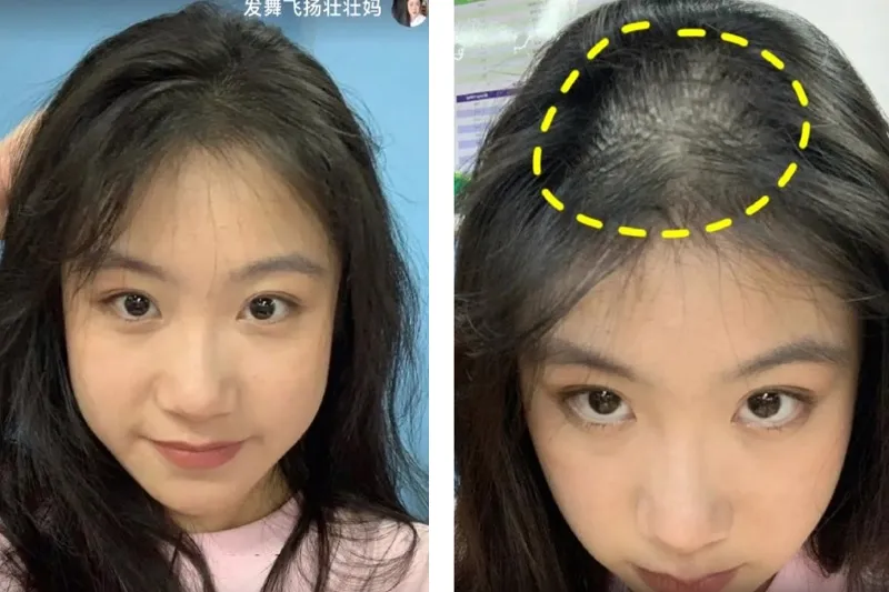 Tóc dài rụng tạo cảm giác nhiều hơn do khối lượng và độ dài của sợi tóc