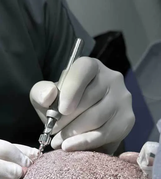 safest-extraction-e28093-manual-punch-fue-technique Cấy tóc tự thân là giải pháp cuối cùng và hiệu quả nhất để lấp đầy các vùng hói lâu năm
