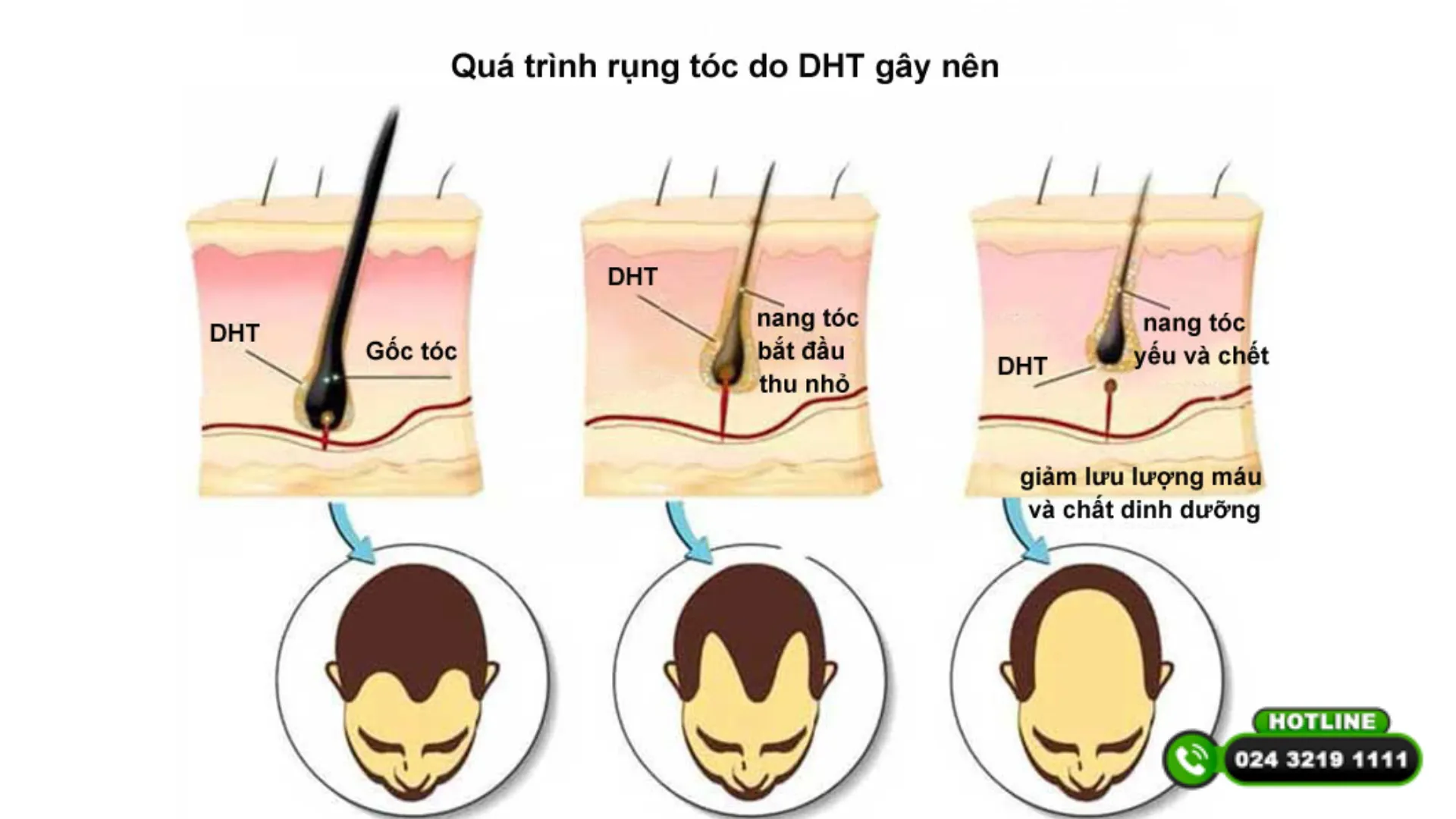 Sự mất cân bằng hormone đặc biệt là sự gia tăng DHT khiến nang tóc bị teo nhỏ và suy yếu