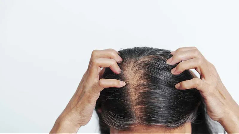 Sự thay đổi của mái tóc trong giai đoạn tiền mãn kinh là nỗi lo chung của nhiều phụ nữ