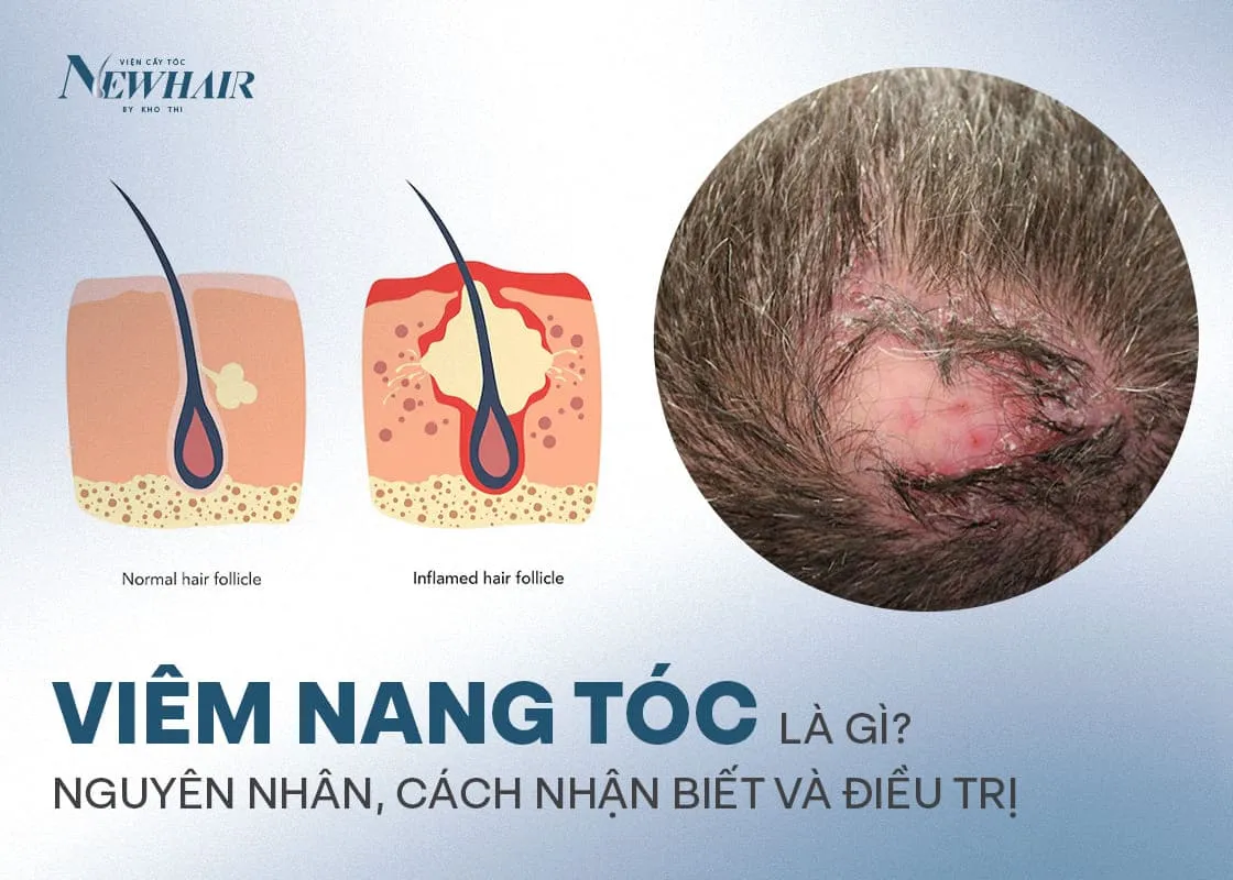Tác động tiêu cực của móng tay gây tổn thương sâu đến cấu trúc nang tóc bên dưới