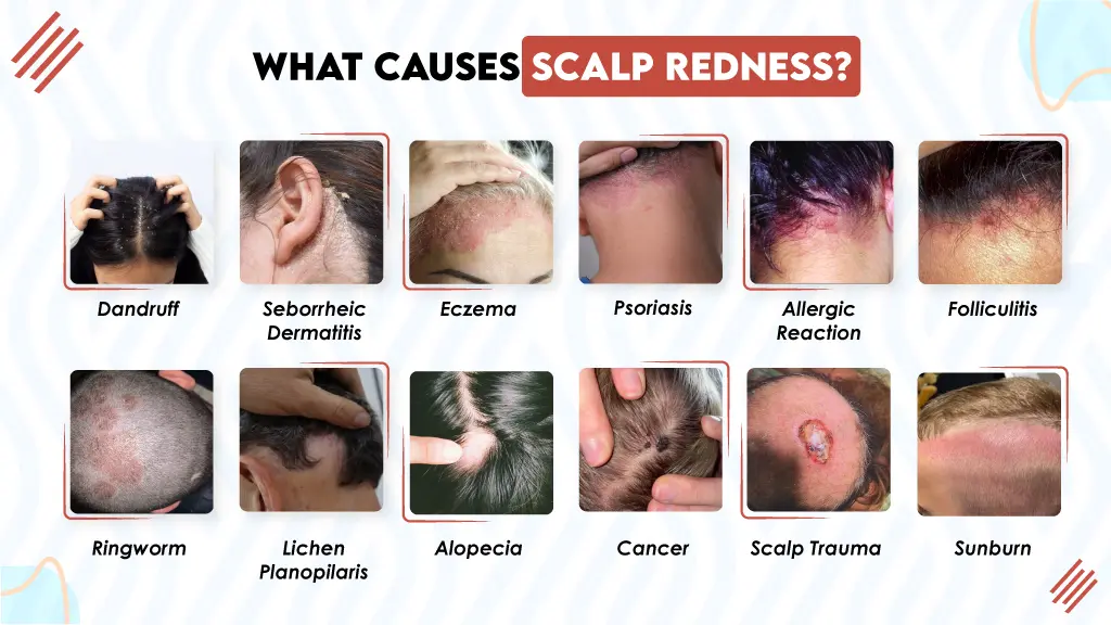 Kích ứng da đầu là tác dụng phụ thường gặp nhất khi sử dụng Minoxidil dạng lỏng